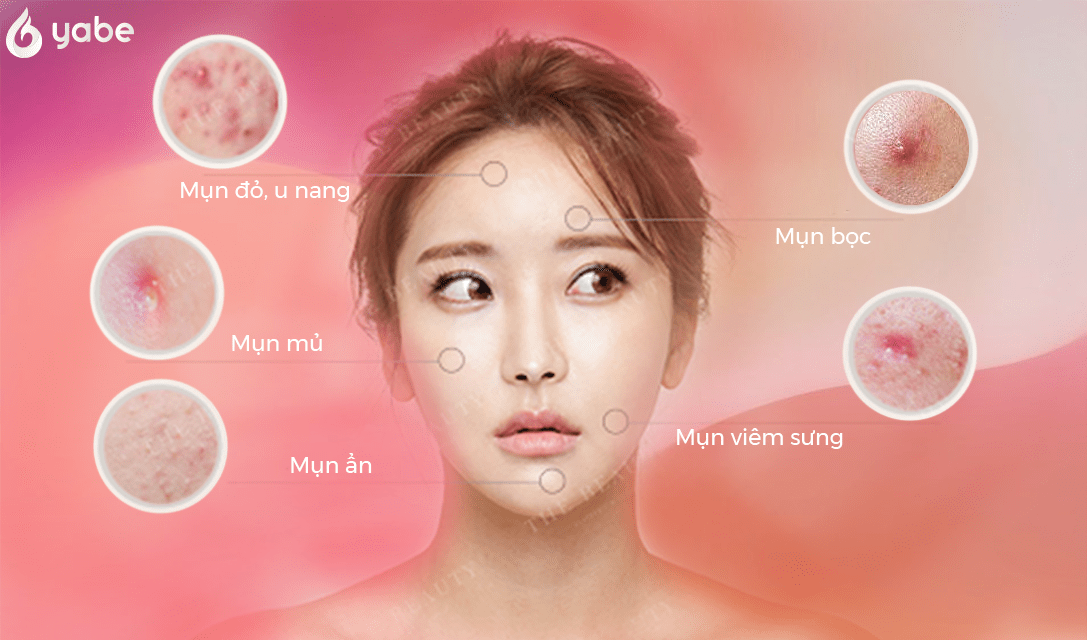 Mụn là gì ? Các loại mụn được hình thành như thế nào ? 18 Các loại mụn thường gặp
