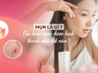 Mụn là gì ? Các loại mụn được hình thành như thế nào ?