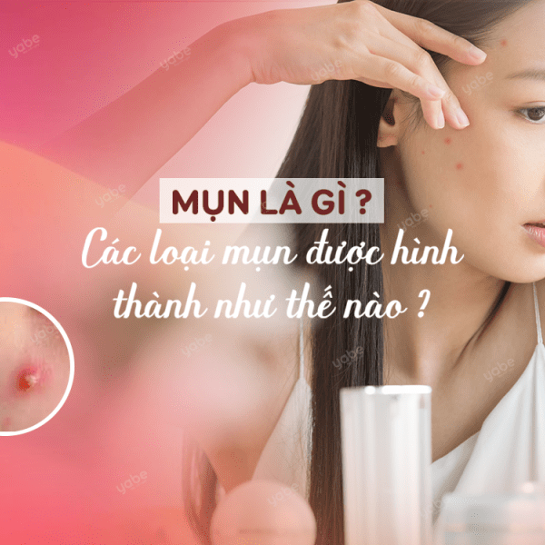 Mụn là gì ? Các loại mụn được hình thành như thế nào ?