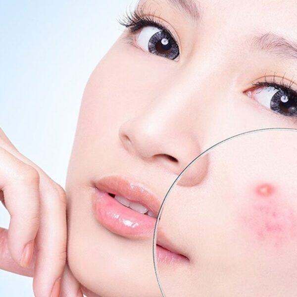 Giảm sưng mụn