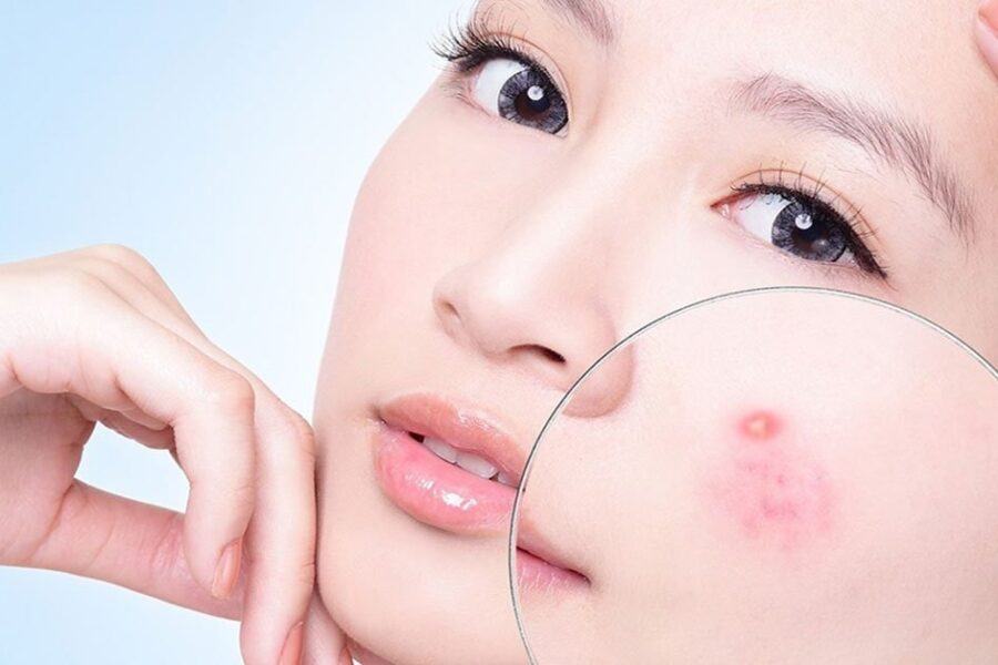 Giảm sưng mụn