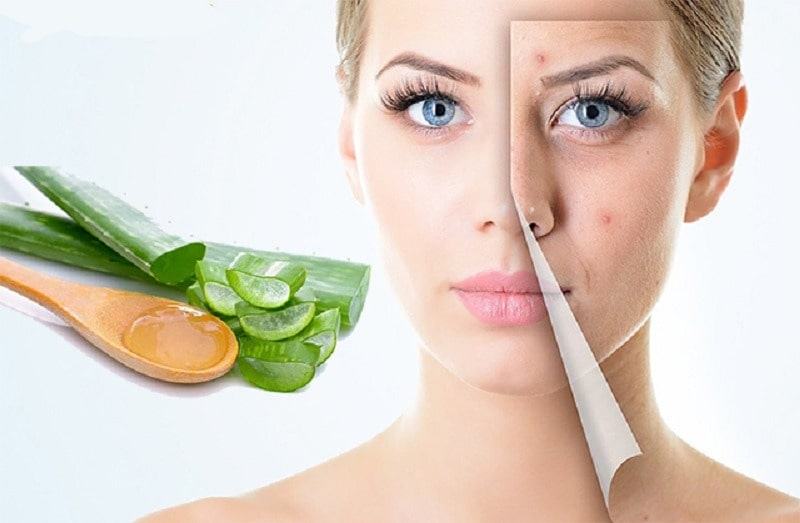 15 cách trị mụn tại nhà hiệu quả từ thiên nhiên 67 Cách trị mụn tại nhà bằng nha đam
