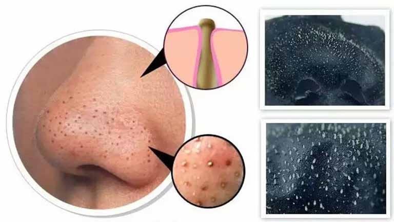 Mụn đầu đen ở mũi - Nguyên nhân và cách điều trị 42 Nguyên nhân hình thành mụn đầu đen