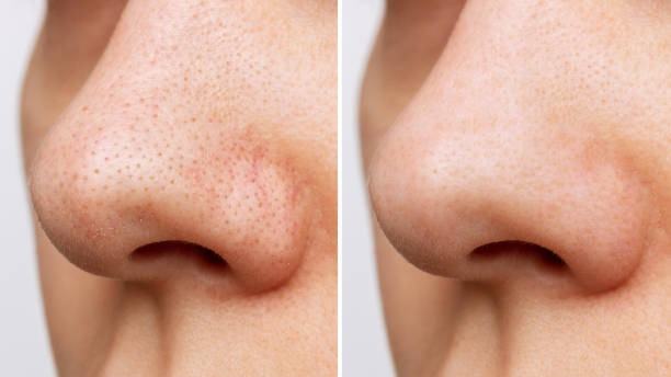 Mụn đầu đen ở mũi - Nguyên nhân và cách điều trị 43 Mụn đầu đen